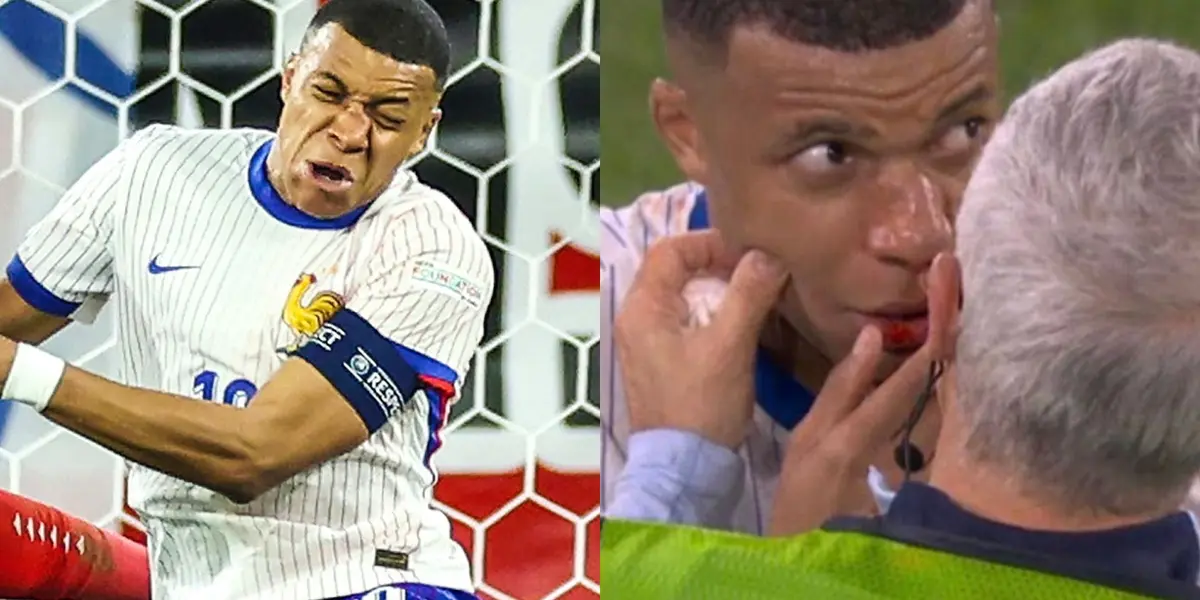 Mbappé y su lesión en su nariz.